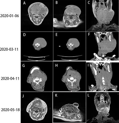 Immunotherapy-Based Therapeutic Strategies for Recurrent Advanced Squamous Cell Carcinoma of the Head and Neck: A Case Report and Literature Review